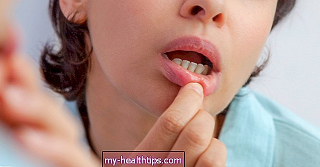 Qual é a diferença entre aftas e herpes labial?