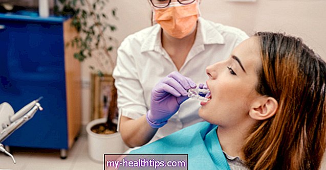 Miksi hampaiden muutos hammashoitojen jälkeen ja ajan myötä