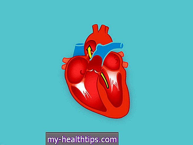 Arteri Cerebellar Inferior Anterior